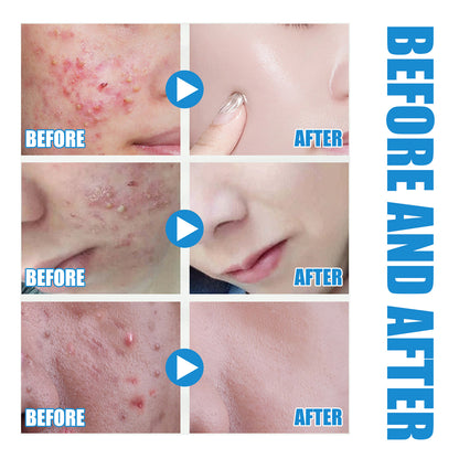 Hyaluronic Acid Replenishment